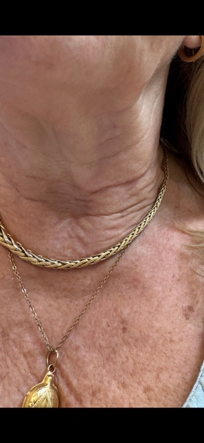 Chest décolletage after exvivo treatment showing reduced redness