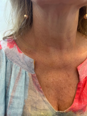 Chest skin texture after exvivo treatment showing smoother skin