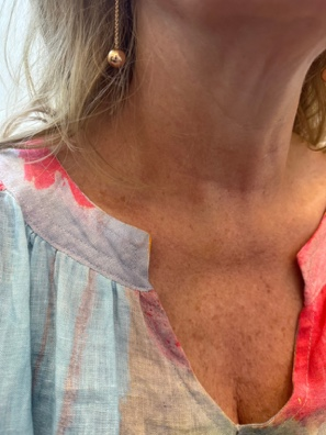 Chest skin texture before exvivo treatment