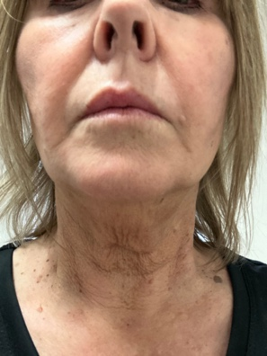 Neck and jawline after exvivo treatment showing improved contour
