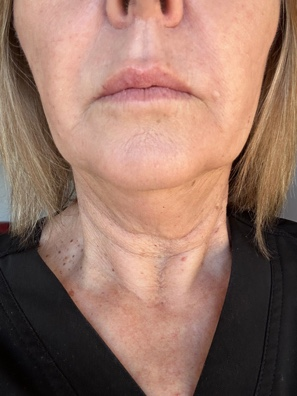 Neck and jawline before exvivo treatment