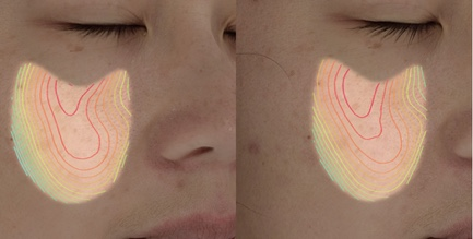Topographic skin texture heat map before and after