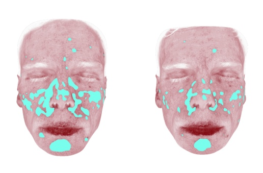 UV porphyrin facial scan showing before and after comparison